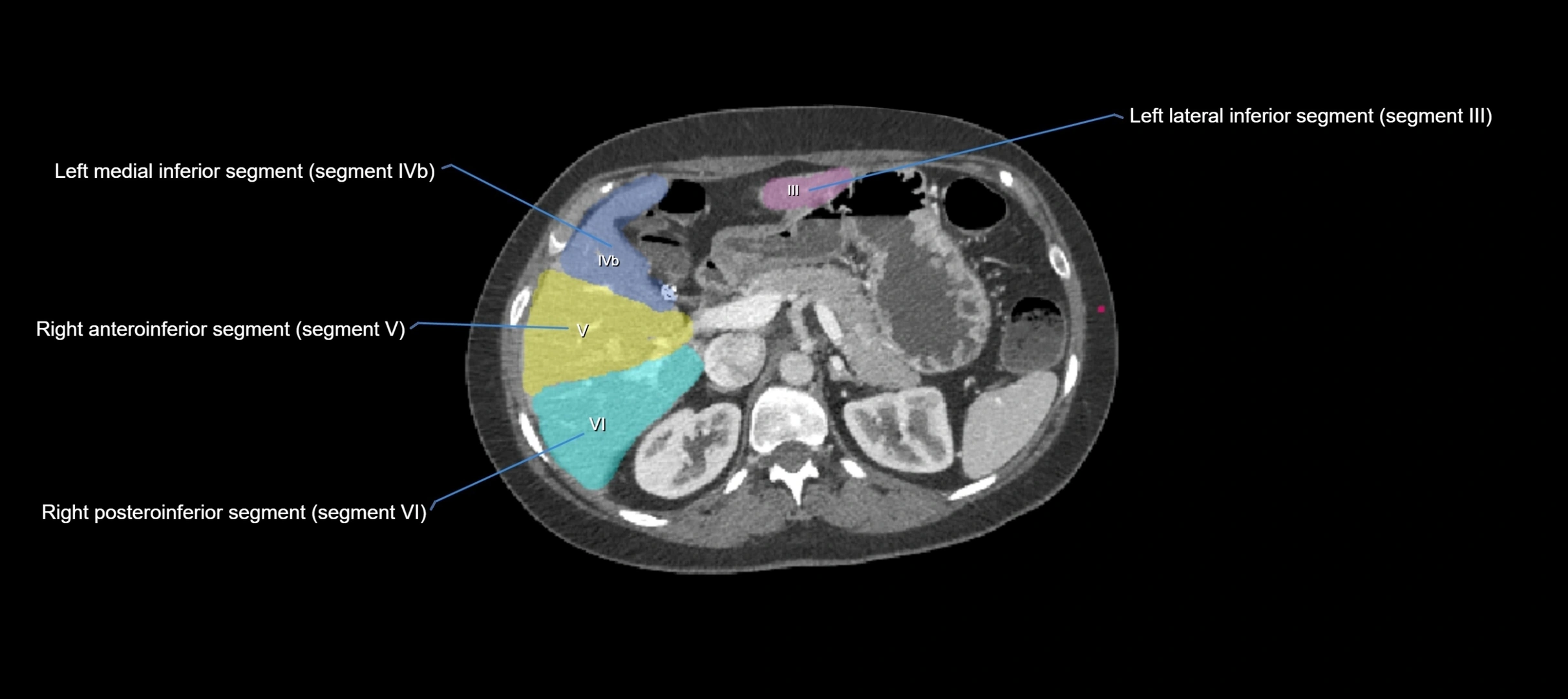 CT liver segments axial cross sectional anatomy labelled image-00039.webp
